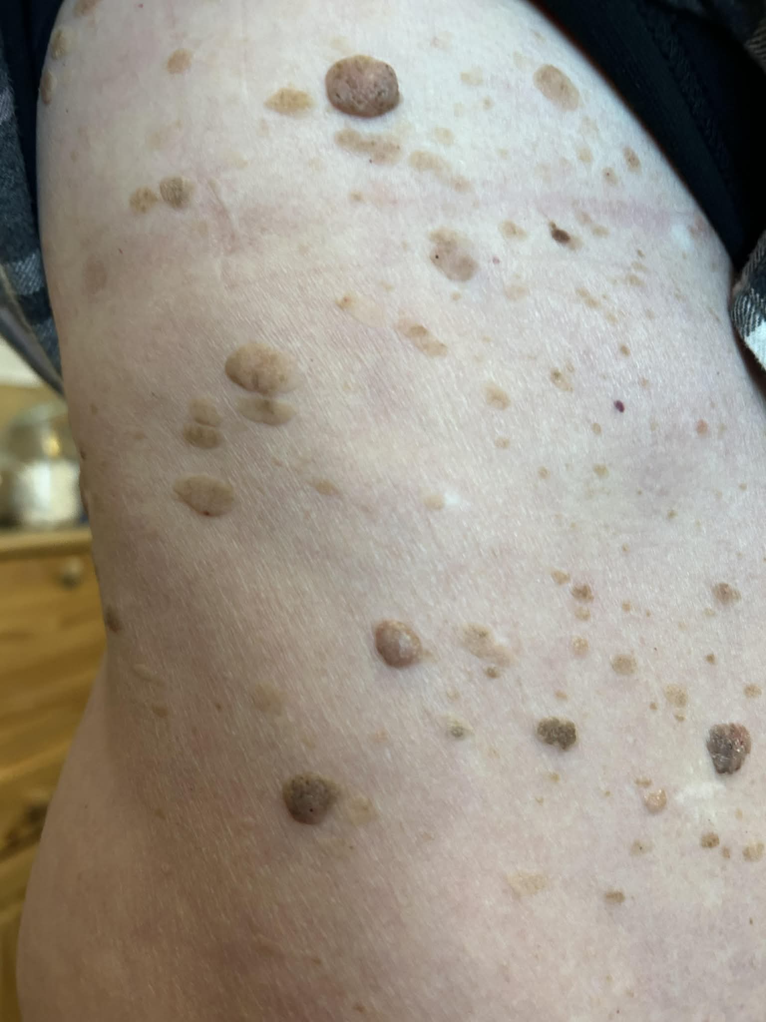 Example of a mole